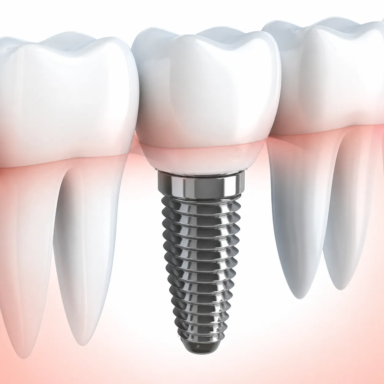 Dental implant diagram showing titanium post, abutment, and crown at Crescent City Dentists